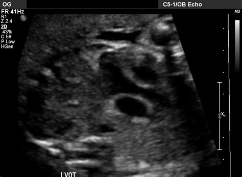 lvot radiopaedia